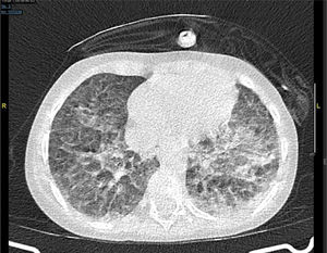 TAC torácica con opacidades bilaterales en vidrio deslustrado.