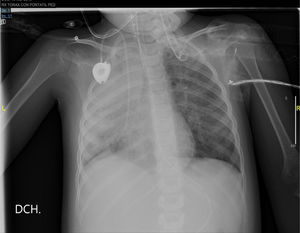 Radiografía de tórax.