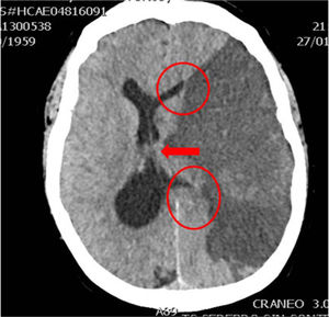 TC craneal con infarto en el territorio de la arteria cerebral media izquierda. Herniación subfalcial con desplazamiento de la línea media y compresión del ventrículo ipsilateral. (Cortesía de Ángela Meilán, Servicio de Radiología del Hospital Universitario Central de Asturias).