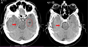 Herniación uncal o transtentorial. A: colapso del asta temporal y de la cisterna ambiens ipsilateral a la lesión expansiva (flecha). Dilatación del asta temporal contralateral (círculo). B: dilatación de la cisterna cerebelopontina ipsilateral (flecha). (Cortesía de Ángela Meilán, Servicio de Radiología del Hospital Universitario Central de Asturias).