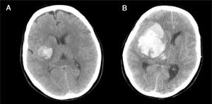 A: TC inicial con pequeña hemorragia en ganglios de la base derechos con colapso parcial del sistema ventricular ipsilateral. B: TC a las 4h de la anterior, con hemorragia masiva hemisférica derecha, invasión ventricular y signos de herniación subfalciana.