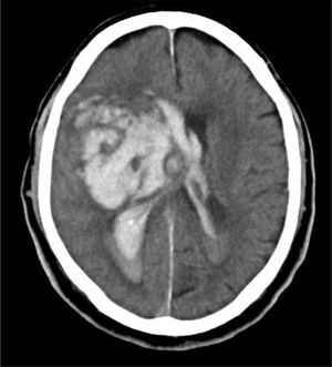 TC craneal con gran hematoma intraparenquimatoso en los ganglios de la base derechos, desplazamiento de la línea media e invasión y dilatación del sistema ventricular.