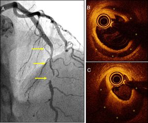 A) Paciente con síndrome coronario agudo (SCA) con una lesión angiográficamente severa y larga (sin doble luz) pero típica de disección coronaria espontánea (DCE), en el segmento medio de la arteria coronaria descendente anterior (flechas). B y C) Imágenes de tomografía de coherencia óptica que demuestran la presencia de una membrana íntimo-medial y un amplio hematoma intramural (asteriscos amarillos) que compromete la luz verdadera. El asterisco blanco señala la sombra causada por la guía; la imagen circular en la luz verdadera corresponde al catéter de imagen intracoronaria.