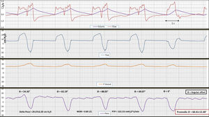 Registro de flujo (flow) y volumen (volume), presión en vía aérea (Paw), presión vesical (Pvesical) y presión esofágica (Peso), en ventilación asistida por volumen y flujo continuo en el primer caso. Nótese en los 4primeros ciclos consecutivos doble ciclado del tipo DTV. En todos los ciclos existe un intenso driver del paciente evidente en el delta de Peso, aunque a menor frecuencia del pautado en el ventilador. Se puede apreciar cómo en el ciclo 5 el paciente desencadena la inspiración del ventilador en forma de asistida típica sin DT ni RT. Como puede apreciarse en la figura, existen 2drivers bien definidos, uno de la máquina y otro del paciente. Ambos son similares en intensidad (WOB del paciente en 0,85J/l y PTP de 222,53cm H2O * s/l). El esfuerzo inspiratorio del paciente es semejante en todos los ciclos (el ciclo n.° 5 asistido, y los 4 primeros DTV), lo que sugiere un vigoroso driver autónomo del paciente (delta esofágico aproximado a 30cmH2O), menos frecuente y regular que el de la máquina, pero en ningún caso un driver inexistente ni «arrastrado» por el ventilador. La medición del desfase angular (θ = 68,41 ± 12,48°) entre el ciclo paciente y el del ventilador es bastante variable, lo que también va en contra de un mecanismo reflejo. No hay desfase en el último ciclo que es asistido. En este caso la relación DT-RT 1:1 apareció en el 60% del registro, siendo el resto variable con una relación 1:2 y 1:3. En este caso destaca el incremento del Vt en los DTV que pasa de 500 cc a casi el doble. Al mismo tiempo se ha reducido la I/E a 1:1, efecto presumiblemente no deseado. Este registro alerta de la necesidad de monitorizar estrechamente cuando se está instaurando una ventilación mecánica pretendidamente protectora.