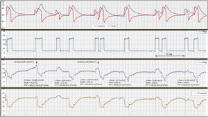 Registro de las señales (flujo y volumen), Paw, Peso y Pvesical durante ventilación con presión de soporte en el caso 2. En este caso, presentamos un doble ciclado definido como DTA, por autociclado del ventilador que precede al driver del paciente (reverse trigger en sentido amplio). El inicio del ciclo del paciente no se hace en este caso por la contracción de los músculos inspiratorios, sino por la liberación de la intensa espiración activa, evidente en señal de presión vesical. La contracción del diafragma es posterior a la relajación de la espiración activa. Pensar que este driver, que incluye liberación de la espiración forzada y posterior esfuerzo inspiratorio del paciente, es producto de algún tipo de reflejo parece muy poco probable. La relación entre el ciclo mecánico y el neural es variable en este caso. Los parámetros relacionados con el esfuerzo inspiratorio: delta de presión esofágica: 11,55 ± 1,22cmH2O, nótese mayor delta de Peso en los ciclos con doble trigger; WOB 1,06 ± 0,42J/l y PTP 183,95 ± 27,59cmH2O * s/min; en este caso, el trabajo respiratorio se ha relacionado con el volumen generado por el ciclo apilado correspondiente a doble ciclado. La aparición del doble ciclado fue de relación variable.