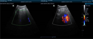Comparación de imágenes obtenidas en modo Doppler previo a la instilación de aire a través de la sonda nasogástrica (izquierda) y durante el procedimiento (derecha).
