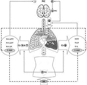 Sistema multicompartimental de interacción de presión intrabdominal, intratorácica e intracraneal. El incremento de la PIA y de la PTT (MR) con Cs baja, y su repercusión sobre las presiones intrapulmonares, condiciona un flujo ascendente de LCR durante la inspiración y dificultad del RVY con el consiguiente incremento de la PIC. Por su parte, el incremento de la PEEP (MR), según el estado de volemia, puede condicionar descenso de la precarga cardiaca y aumento de la postcarga del ventriculo derecho. Abreviaturas: Cs: Distensibilidad pulmonar, PTT: Presión transtorácica, Δ P: Presión motriz, PL: Presión transpulmonar, PIA: Presión intraabdominal, PEEP: Presión positiva fin espiración, LCR: Líquido cefaloraquídeo, RVY: Retorno venoso Yugular, PPC: Presión perfusión cerebral, PIC: Presión intracraneal, MR: Maniobra de reclutamiento.