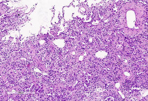 Muestra de criobiopsia pulmonar. Obliteración de luces alveolares por engrosamiento septal por depósitos de colágeno (hematoxilina-eosina ×10).