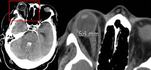 Medición en la TC craneal de la vaina del nervio óptico