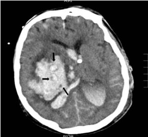 Hemorragia en ganglios basales derechos con vertido ventricular y desplazamiento de línea media. En el interior del hematoma se observa el «signo del remolino», las flechas indican áreas con diferentes densidades; las pequeñas áreas hipodensas se corresponden con focos de sangrado activo por arteriolas y vénulas