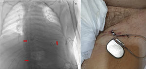 A. Radiografía de tórax (negativizada) en la que se aprecia el electrocatéter (flechas rojas) en el ventrículo derecho vía vena cava inferior. B. Generador de pulsos conectado al electrocatéter de fijación activa implantado por vía femoral.