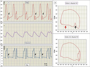 A) Flujo, volumen y presión en vía aérea (Paw) vs. tiempo. B) Bucles flujo-volumen (F/V). En las señales de flujo y Paw se aprecia doble ciclado de 2-3, 3-4 y 8-9. El resto de los ciclos muestran los hallazgos habituales de reverse trigger y/o cierre precoz de la inspiración, flechas verticales largas en los ciclos 1, 6 y 7. El bucle F/V del ciclo 1 y del 2-3 muestra los mismos hallazgos de la curva flujo tiempo, pero magnificados. Los bucles muestran además, el ondulado espiratorio bastante típico de la espiración activa, flechas rojas pequeñas.