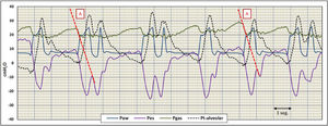 Registro de las señales de presión en vía aérea (Paw), esofágica (Pes), gástrica (Pgas) y transalveolar (Pt-alveolar). En la señal de Pgas, podemos apreciar, la existencia de espiración activa, y cómo su liberación genera el inicio del ciclo mecánico, seguido del esfuerzo de los músculos inspiratorios como se objetiva en Pes. La desaparición del estímulo generado por la espiración activa, provoca un cierre precoz de la inspiración y hace más evidente el esfuerzo inspiratorio simulando reverse trigger. El vigoroso esfuerzo del paciente genera Pt-alveolar superior a los 30cmH2O causando de sobredistensión e hiperinsuflación pulmonar.
