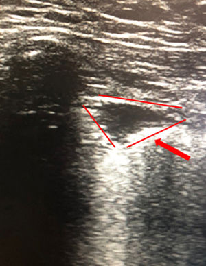 Imagen hipoecogénica triangular de base periférica compatible con infarto pulmonar.