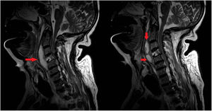 Colección abscesificada en espacio prevertebral C1-C5, hiperintensa en T2, que continúa con otra colección C5-D1 (flechas).