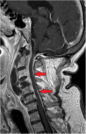 Afectación epidural que rodea el cordón medular de C2 a C6, en secuencia T1 (flechas).