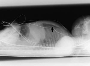 Radiografía de tórax lateral con rayo horizontal. Neumotórax anterior bilateral.