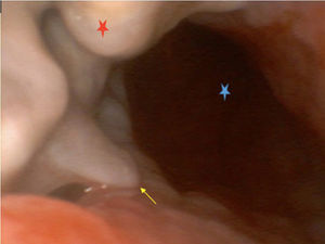 Imagen de videobroncoscopia.