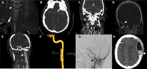 Aspectos radiológicos de los pacientes con lesión cerebrovascular traumática. A: disección de arteria vertebral derecha con imagen arrosariada y buen flujo distal (tipo i de Denver). B: disección de arteria carótida interna supraclinoidea izquierda, flujo filiforme (tipo iv de Denver). C: trombosis seno venoso transverso y vena yugular derecha. D: trombosis venosa seno sigmoideo derecho. E: disección de arteria carótida izquierda con desarrollo de pseudoaneurisma (tipo iii de Denver). F: arteriografía con reconstrucción 3D de pseudoaneurisma (3cm de eje longitudinal) en el segmento extracraneal posbulbar de arteria carótida izquierda. G: disección del segmento extracraneal posbulbar con la presencia de 2 pseudoaneurismas en arteria carótida interna derecha. H: hematoma epidural hiperagudo tras inicio de anticoagulación.