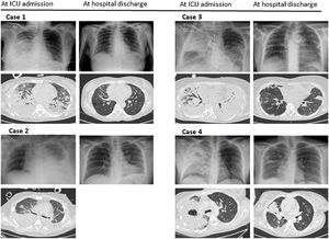 Thorax X-ray and thoracic CT-scan at ICU admission and at hospital discharge.