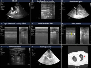 Hallazgos más frecuentes en pacientes con insuficiencia respiratoria aguda. A)Imágenes de PLAPS mostrando zonas hiperecoicas que delimitan un borde mal definido (flecha pequeña) y derrame pleural (flecha grande). B)Consolidación subpleural consistente en zona hipoecoica en contacto con la línea pleura, rodeada de borde hiperecoico irregular (shred sign). C)Imagen de broncograma aéreo mostrando líneas hiperecoicas (flecha pequeña) en el seno de un pulmón hepatizado rodeado de derrame pleural adyacente (flecha grande). D)Patrón en «código de barras», también denominado «de la estratosfera» en el modoM, correspondiente a un neumotórax. E)Patrón de «orilla de la playa» de un pulmón con un deslizamiento pleural preservado. F)ModoM colocado (izquierda) en la zona correspondiente al punto pulmón (flecha, imagen derecha); se puede observar cómo oscilan los patrones en orilla de la playa (flechas blancas) y en código de barras (flecha amarilla) en relación a las fases inspiratoria y espiratoria. G)Imagen de trombo en la vena yugular interna que aparece como hiperecoica, ocupando la mayor parte de la luz vascular. H)Infarto pulmonar: zona hipoecoica, con imagen hiperecoica en su interior (tomada con sonda de baja frecuencia) que se corresponde con árbol bronquial. I)Región de infarto pulmonar (flecha roja) en la tomografía computarizada pulmonar del mismo paciente.
