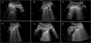Hallazgos frecuentes en pacientes con insuficiencia respiratoria aguda asociada a COVID-19. Incluye la presencia de líneasB en todas sus formas posibles, separadas o coalescentes, llegando incluso a formar una imagen de «pulmón blanco». Pueden partir de la línea pleural o de pequeñas consolidaciones periféricas. A)LíneasB separadas. B)LíneasB coalescentes. C)«Pulmón blanco». D)Línea pleural irregular y fragmentada. E y F)Consolidaciones subpleurales.