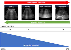 Patrones ecográficos de aireación pulmonar. A)Patrón de líneasA, aireación normal. B)B ≥3, líneasB separadas que indica moderada pérdida de aireación. C)Líneas B coalescentes, pérdida grave de aireación. C)Patrón tisular o de consolidación, pérdida completa de aireación. A cada patrón le corresponde una puntuación para generar el Lung Ultrasound Score (LUS).
