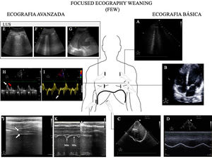 Principales exploraciones ecográficas utilizadas para el diagnóstico de la causa del fracaso de la retirada de la ventilación mecánica. Se dividen en exploraciones que precisan un conocimiento básico de ecografía y exploraciones que precisan un grado avanzado de formación en ecografía. A)Ecografía pulmonar con detección de un aumento ≥6 líneasB durante la prueba de respiración espontánea para el diagnóstico de edema pulmonar inducido por el weaning (WIPO). B)Ecografía cardiaca, plano apical 4cámaras para estudio de la función sistólica del ventrículo izquierdo y el estudio de alteraciones estructurales del mismo (hipertrofia, dilatación, insuficiencia mitral grave). C)Estudio del diafragma mediante la excursión, en imagen en 2dimensiones (ver vídeo del material electrónico suplementario). D)Estudio del diafragma mediante la excursión, imagen en modoM; obsérvese la onda generada por el desplazamiento diafragmático con los movimientos respiratorios (una excursión <10mm se considera patológica). E-G)Imágenes utilizadas para el cálculo del Lung Ultrasound Score (LUS) tal y como se describe en el texto. H)Estudio de la función diastólica, imagen de Doppler pulsado del flujo transmitral mostrando las ondas de llenado temprano (E, flecha blanca) y tardío (A, flecha roja). I)Estudio de función diastólica, imagen de Doppler tisular del anillo mitral lateral mostrando la ondae’ (flecha blanca). J)Imagen en modo bidimensional del diafragma en la zona de aposición sobre el noveno espacio intercostal; el diafragma es la estructura localizada ente las dos líneas hiperecogénicas identificadas con la flechas (superior pleura, inferior diafragma, vídeo del material electrónico suplementario). K)Imagen en modoM para el estudio de la fracción de engrosamiento diafragmática identificando el grosor máximo en la inspiración y el mínimo en la espiración.