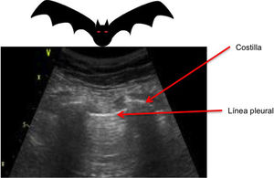 «Signo del murciélago» o bat sing. «Signo del murciélago», se denomina así a la imagen formada por la línea pleural entre la sombra acústica que generan dos costillas consecutivas cuando colocamos nuestro transductor en posición longitudinal.