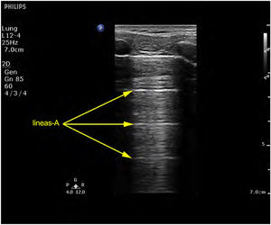 Líneas A. Patrón de líneas A, artefactos hiperecogénicos horizontales que no son más que la repetición de la línea pleural.
