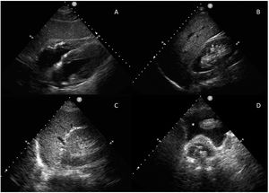 Estudio FAST. Ventanas ecográficas: pericárdica (A), flanco derecho (B), flanco izquierdo (C) y pélvica (D). +: globo de la sonda vesical; *: líquido libre.