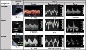 Sistema de clasificación de la congestión venosa (VExUS). D: diástole; IP: índice de pulsatilidad; S: sístole; VCI: vena cava inferior. Grado0: VCI inferior a 2cm, patrones normales. Grado1: VCI >2cm y patrones ligeros. Grado2: VCI >2cm y un órgano con patrón grave. Grado3: al menos dos órganos con patrón grave. Con frecuencia el flujo renal incluye arteria (positiva, siempre pulsátil) y vena (bajo línea cero), al discurrir paralelas.