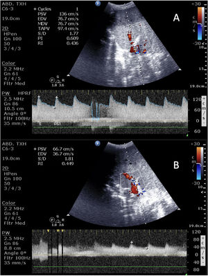 Doppler de estenosis de la arteria hepática (A) y patrón parvus-tardus postestenótico (B).