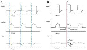 Descripción esquematica de trigger reverso. Panel A) se observa una ventilación espontánea, en un modo VC, donde el inicio del esfuerzo realizado por el paciente (líneas punteadas azules) anteceden el inicio del ciclo ventilatorio mandatorio (líneas continuas rojas). Panel B) Se observa una asincronía de TR donde destaca la ocurrencia desfasada D) del esfuerzo respiratorio del paciente (deflexion negativa Pes y línea punteada azul) en comparación con el inicio del ciclo de ventilación mandatoria (línea continua roja). El color de la figura solo puede apreciarse en la versión electrónica del artículo. D: desfase; Pes: presión esofágica; TR: trigger reverso; VC: volumen controlado.