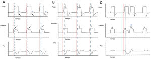 Detección de trigger reverso mediante inspeción visual. Panel A) se observa una ventilación en modo VC, con la aparición de un TR de activación media y relajación tardía, con un patrón 1:1, las líneas rojas indican el inicio mandatorio y las líneas discontinuas azules la respuesta del diafragma. En la curva de flujo-tiempo las flechas continuas muestran la amputación del flujo espiratorio, la estrella muestra el intento de positividad del flujo durante la fase espiratoria. En la curva de presión-tiempo las flechas discontinuas señalan la caída de la presión pico. Panel B) se observa una ventilación en modo PC, con la aparición de un TR de activación media y relajación rápida, con un patrón 1:1, las líneas rojas indican el inicio mandatorio y las líneas discontinuas azules la respuesta del diafragma. En la curva de flujo-tiempo, las flechas discontinuas muestran un aumento del flujo durante la desaceleración del mismo, en la curva de presión-tiempo, las flechas continuas muestran una caída leve de la presión de la vía aérea. Panel C) se observa una ventilación en modo VC, con la aparición de un TR de activación media y relajación tardía, que desencadena un doble ciclado, las líneas rojas indican el inicio mandatorio y las líneas discontinuas azules la respuesta del diafragma. En la curva de presión-tiempo la estrella señala el doble ciclado. El color de la figura solo puede apreciarse en la versión electrónica del artículo. PC: presión controlado; Pes: presión esofágica; TR: trigger reverso; VC: volumen controlado.