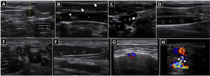 Ultrasound-guided vascular cannulation. A) Preprocedural assessment of a peripheral vein for ultrasound-guided cannulation. The anteroposterior diameter of the vein (continuous yellow line, Distancia 2) and distance from the vein to the skin (continuous green line, Distancia 1) are measured. B) In-plane cannulation of the internal jugular vein (v); arrows, needle shaft; arrowhead, needle tip. C) Out-of-plane cannulation of the internal jugular vein (v); a, common carotid artery; arrow, needle. D) The guidewire is observed in the vein lumen (arrows) before placement of a long catheter in the basilic vein (e.g., midline catheter); v, vein. E) A peripheral venous catheter (arrow) is observed in the lumen of a deep vein of the arm (short axis); v, brachial veins; a, brachial artery. F) A peripheral catheter (arrows) is depicted in the lumen of a superficial vein in the long axis; v, vein. G) Subperiostial flow is observed on color Doppler after intraosseous needle insertion. H) Pseudoaneurysm as a complication of femoral arterial catheterization; black arrows, pseudoaneurysm cavity; white arrows, pseudoaneurysm neck; a, common femoral artery; v, common femoral vein.