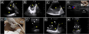 Ultrasound-guided thoracentesis. A) A simple pleural effusion (asterisks), diaphragm (d) and lung (L) are delineated using ultrasound. B) A complex pleural effusion (asterisk) is observed; d, diaphragm. C) The best fluid pocket for thoracentesis is selected by measuring the distance from the skin to the pleural effusion (asterisk) and the effusion depth; L, lung; d, diaphragm. D) The intercostal vessels are delineated before cannulation using a linear transducer and color Doppler. E) The insertion site is marked on the skin. F) Dynamic ultrasound guidance for thoracentesis. Arrows, needle shaft; arrowhead, needle tip; asterisk, pleural effusion; L, lung. G) The guidewire (arrows) is observed within the pleural effusion (asterisks); d, diaphram. H). A central catheter (arrows) is observed within the pleural effusion (asterisks); L, lung.
