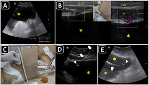Ultrasound-guided paracentesis. A) Ascites is observed (asterisk), and the distance from the skin to the effusion and to a bowel loop (b) is obtained. B) The inferior epigastric vessels (boxes) are delineated into the abdominis rectus sheath using a linear probe on two-dimensional and color Doppler imaging; s, skin; sct, subcutaneous tissue; m, rectus abdominis muscle; asterisk, ascites. C) The insertion site is marked on the skin, and puncture is performed under static guidance. D) Real-time ultrasound-guided paracentesis; arrows, needle shaft; arrowhead, needle tip; asterisk, ascites. E) A locking pigtail catheter is observed within the ascites (asterisks). The arrow indicates the body, whereas the arrowhead indicates the tip of the pigtail.