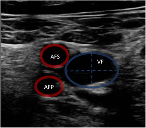 Ecografía vascular femoral. Imagen ecográfica vascular y representación gráfica de circunferencia y diámetros de vena (VF) y arterias femorales superficial (AFS) y profunda (AFP).