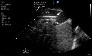 Ecografía transesofágica de canulación fémoro-yugular para ECMO VV. Cánula de drenaje de ECMO (flecha) a la altura de la vena cava inferior (VCI) y extremo a nivel de drenaje de vena suprahepática (VSH) derecha.