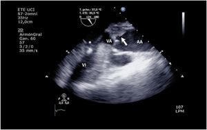 Ecografía transesofágica de válvula aórtica trombosada en paciente con EMCO VA. Válvula aórtica VA cerrada con trombo (flecha) a nivel de senos de Valsalva en paciente con ECMO VA y cánula de drenaje ventricular (*). AA: aorta ascendente; VI: ventrículo izquierdo.