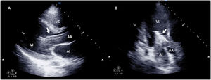Ecografía transtorácica (ETT) de Impella® en paciente con ECMO VA. ETT paraesternal de eje largo (A) y apical de 3 cámaras (B) de Impella® (flecha) a nivel de ventrículo izquierdo (VI). AA: aorta ascendente; AI: aurícula izquierda; VD: ventrículo derecho.