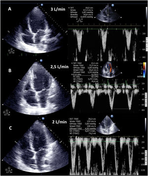 Evaluación ecocardiográfica de destete de paciente con ECMO VA. Ecografía transtorácica e integral velocidad-tiempo (IVT) del tracto de salida del ventrículo izquierdo al reducir flujo (A: 3L/min, B: 2,5L/min, C: 2L/min) de ECMO VA. Obsérvese el aumento del tamaño de la IVT y consecuentemente del volumen sistólico y del gasto cardiaco.