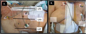 A) LAA: línea axilar anterior; LAP: línea axilar posterior; LPE: línea paraesternal; 1: área anterior-superior izquierda; 2: área antero-inferior izquierda; 3: área lateral-superior izquierda; 4: área lateral-inferior izquierda.