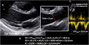 Estimación del volumen sistólico (VS) y del gasto cardiaco (CO) a través de la integral de velocidad (VTI) y radio (r) del tracto de salida del ventrículo izquierdo (TSVI). A) Paraesternal izquierdo ventrículo izquierdo en sístole. B) Zoom TSVI. C) Doppler pulsado TSVI 5C apical. D) Cálculos.