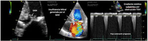 PC de bypass coronario en paciente con hipertrofia del VI concéntrica: obstrucción dinámica TSVI por exceso de soporte inotrópico e hipovolemia postoperatoria, generando insuficiencia mitral severa por movimiento septal anterior (SAM). Obsérvese el flujo de aceleración progresiva por Doppler continuo.