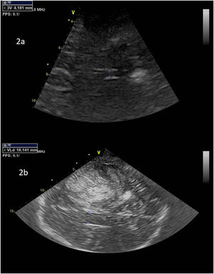 Ejemplo de medición del tamaño ventricular. 2a corresponde a tercer ventrículo. 2b corresponde a asta frontal VL contralateral.