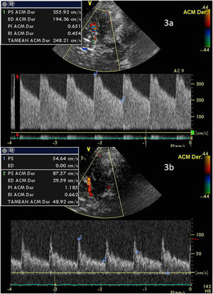 Mujer con vasoespasmo en ACM izquierda (Vm de 248cm/seg e IP 0,65) (3a). Tras angioplastia mecánica, se observa flujo lineal con patrón hemodinámico normalizado (Vm 48cm/seg e IP 1,1) (fig. 3b).