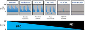 Patrones clásicos y cronológicos de paro circulatorio cerebral y su relación con presión de perfusión cerebral (PPC) y presión intracraneal (PIC). TAD: tensión arterial diastólica; TAS: tensión arterial sistólica.