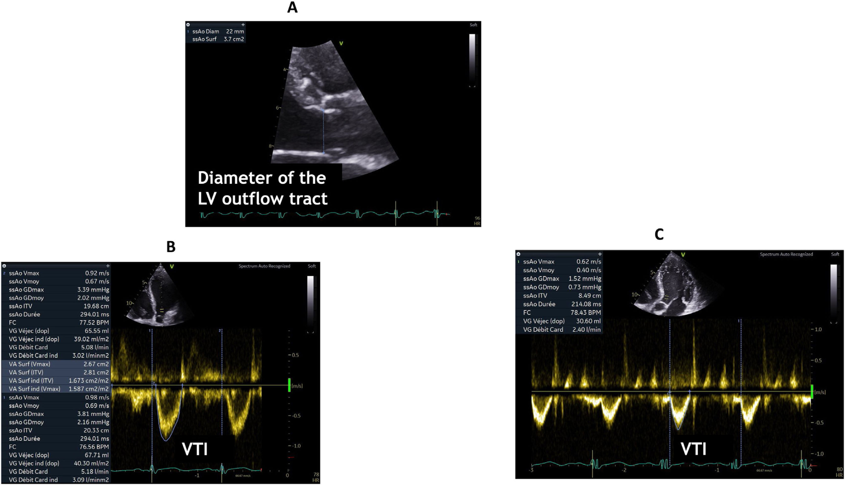 How to use echocardiography to manage patients with shock? | Medicina ...